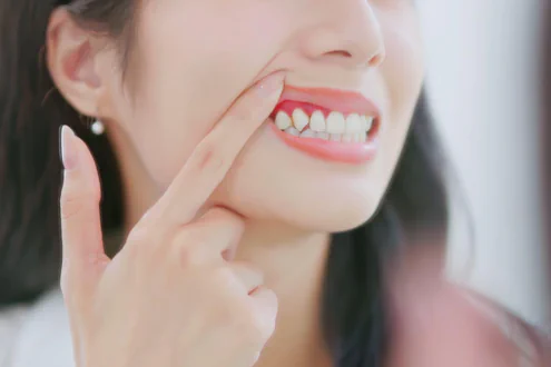 Woman with irritated gums.