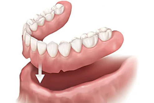 Slipping dentures at at keith + associate dentistry implant center.